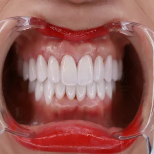 Bản chất của răng sứ – Bí mật phía sau nụ cười hoàn hảo