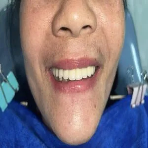 Implant toàn hàm All on tại nha khoa Bách Quyết cho cụ bà 70 tuổi