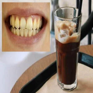 Tại Sao Răng Bị Ố Vàng? 7 Sự Thật Khiến Bạn Phải Giật Mình – Chuyên Gia Nha Khoa Tiết Lộ!