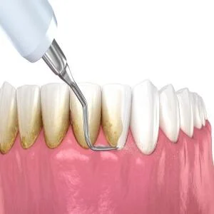 Cạo Vôi Răng Định Kỳ – Giữ Gìn Sức Khỏe Răng Miệng