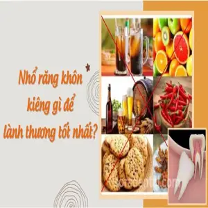 Sau khi nhổ răng khôn nên kiêng gì? Bao lâu thì lành?