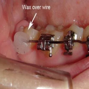 Dây Cung Cạ Vào Má Khi Niềng Răng: Nguyên Nhân & Cách Khắc Phục