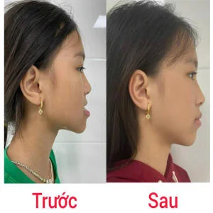Sau 8 tháng niềng răng em gái tự tin hơn với nụ cười của mình