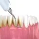 Cạo Vôi Răng Định Kỳ – Giữ Gìn Sức Khỏe Răng Miệng