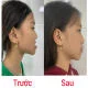 Sau 8 tháng niềng răng em gái tự tin hơn với nụ cười của mình