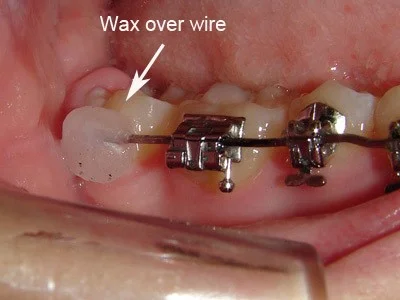 Dây Cung Cạ Vào Má Khi Niềng Răng: Nguyên Nhân & Cách Khắc Phục